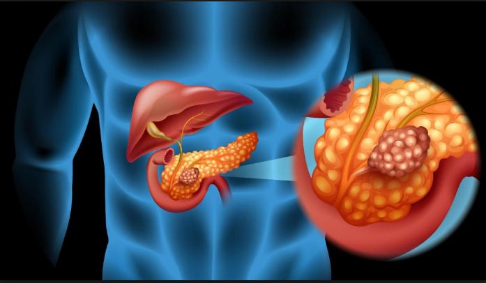 Pancreatic Cancer Symptoms What Are The Manifestations Of Pancreatic